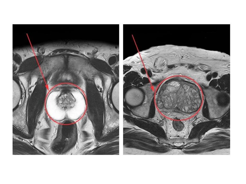 Comparația unei prostate sănătoase (stânga) și inflamată (dreapta) pe imaginile RMN